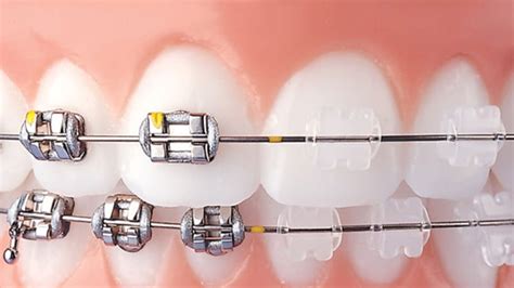 brackets ceramicos o metalicos|Ventajas de los brackets de cerámica vs brackets metálicos .